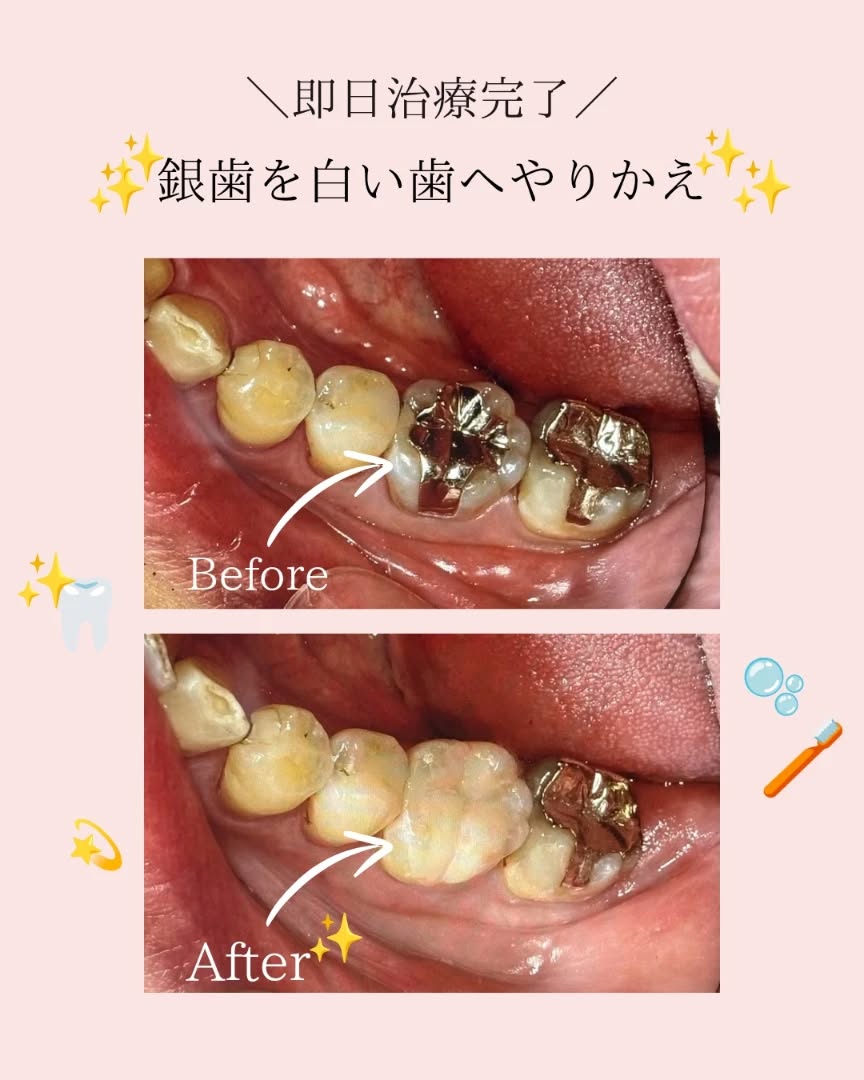 、
こんにちは、たちばな歯科です🦷🍀
銀歯を白い詰め物へ✨
保険の詰め物では
噛む力などの力の負担で
かけやすくなります🙅
強度を重視して詰める今回の治療は
力がかかりやすい奥歯にも適応可能です✨
一日で治療も完了します👍
詳しくはスタッフまでお気軽に
お尋ね下さい✨
#ダイレクトボンディング法
#たちばな歯科矯正歯科
#玉津インターすぐ
#虫歯
#審美歯科治療