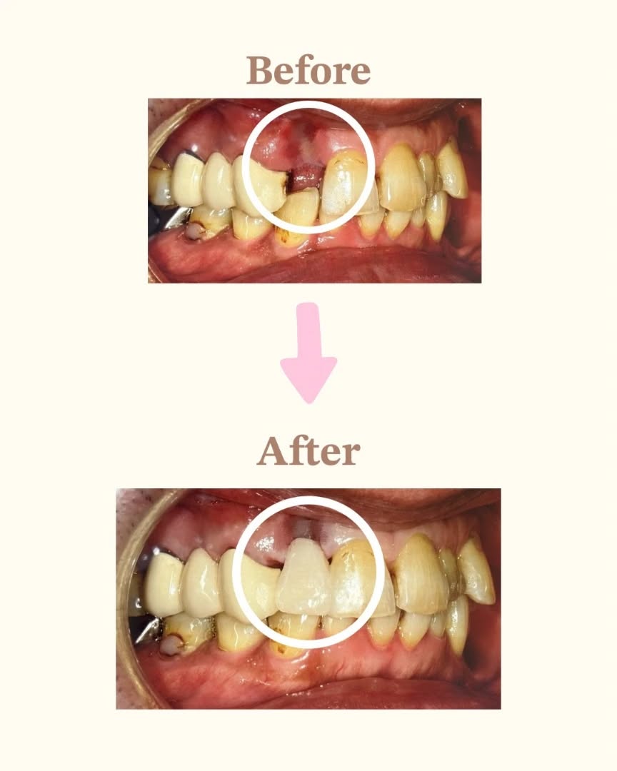 こんにちは🦷🪥
#たちばな歯科 です

今回は #crブリッジ　について紹介します☀️

従来のブリッジは両サイドの歯をたくさん削り、型取りをして後日被せます🫥

しかしこのCRブリッジは、両サイドの歯を削らずとても強い接着剤で🌸その日に白い歯を完成させます🦷🌸🤍

また従来のブリッジなら銀歯になるので、見た目が… という方にもオススメです!

歯を削らないので歯にも優しく、見た目も綺麗でしっかりお食事もできます💎

気になる方はスタッフまでお気軽にお声掛けください🙌

#たちばな歯科  #玉津インターすぐ #審美歯科 審美歯科治療 即日完成 神戸歯医者